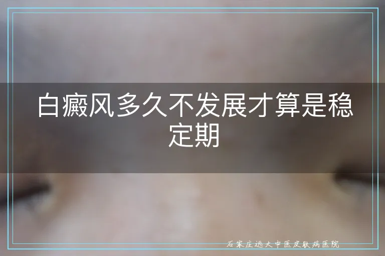 白癜风多久不发展才算是稳定期