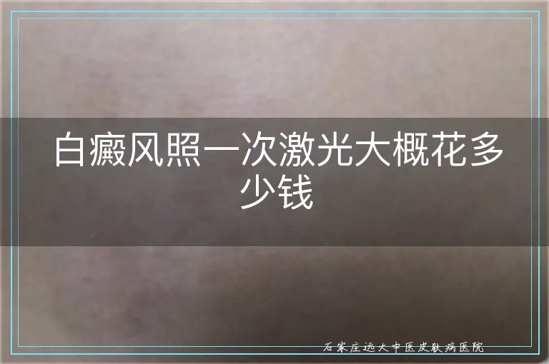 白癜风照一次激光大概花多少钱