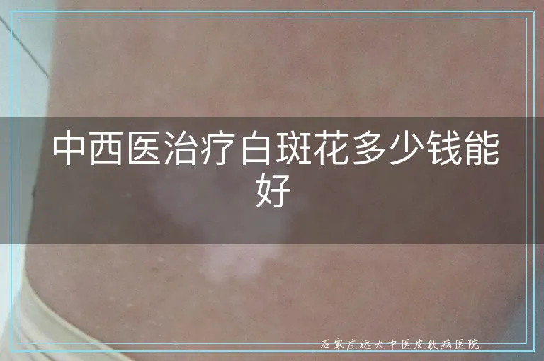 中西医治疗白斑花多少钱能好