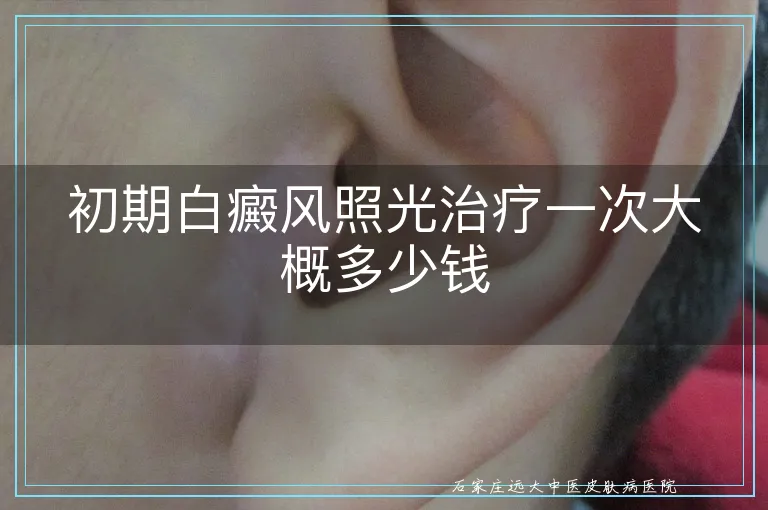 初期白癜风照光治疗一次大概多少钱
