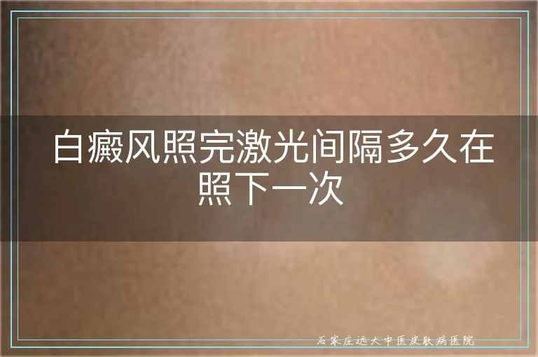 白癜风照完激光间隔多久在照下一次