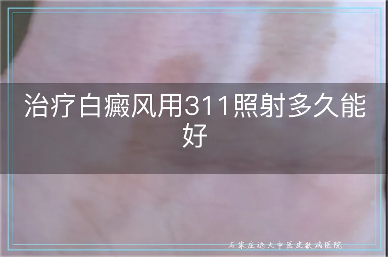 治疗白癜风用311照射多久能好