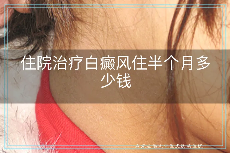 住院治疗白癜风住半个月多少钱