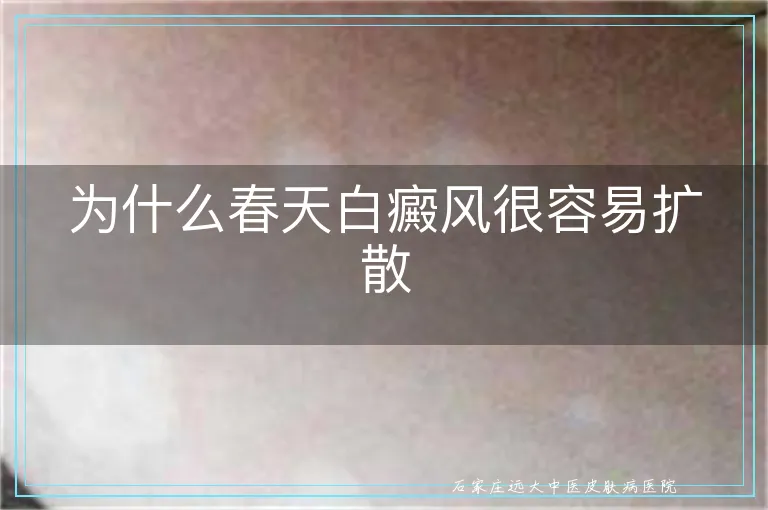 为什么春天白癜风很容易扩散