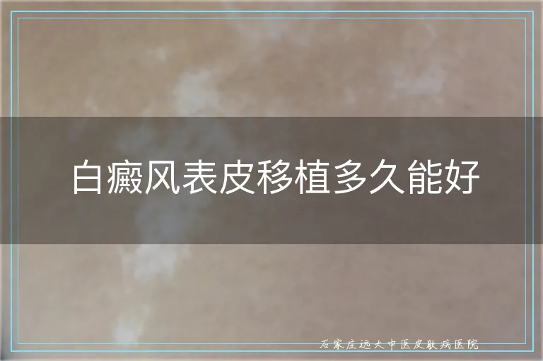 白癜风表皮移植多久能好