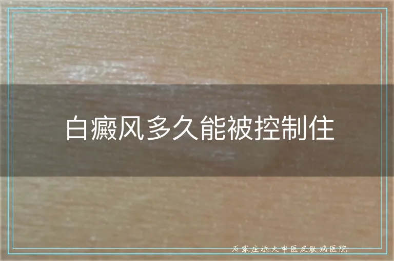 白癜风多久能被控制住