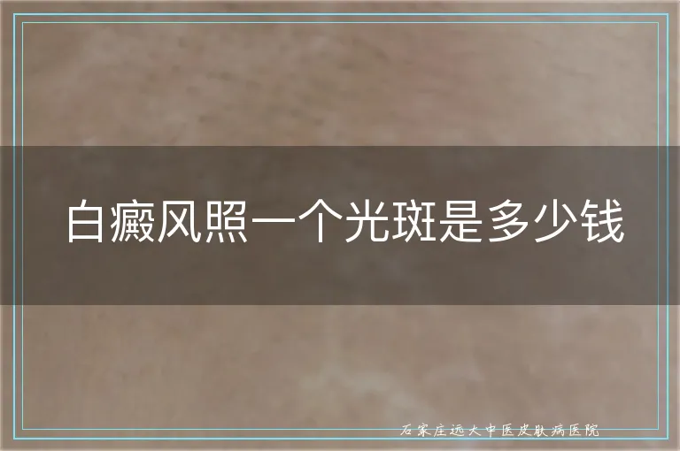 白癜风照一个光斑是多少钱