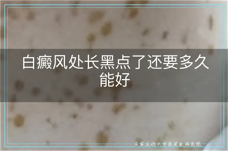 白癜风处长黑点了还要多久能好