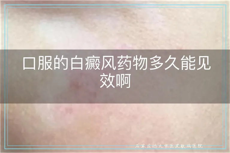口服的白癜风药物多久能见效啊