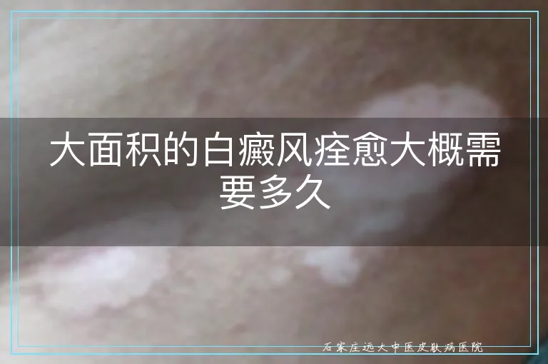 大面积的白癜风痊愈大概需要多久