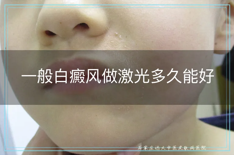 一般白癜风做激光多久能好