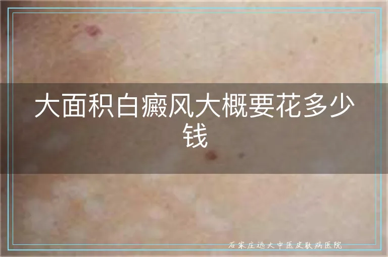 大面积白癜风大概要花多少钱