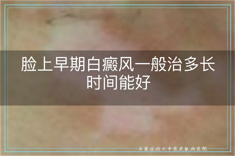 脸上早期白癜风一般治多长时间能好