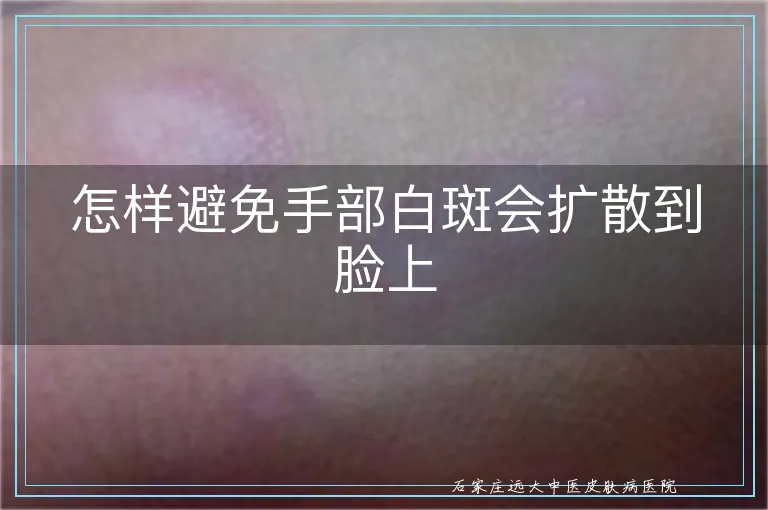 怎样避免手部白斑会扩散到脸上