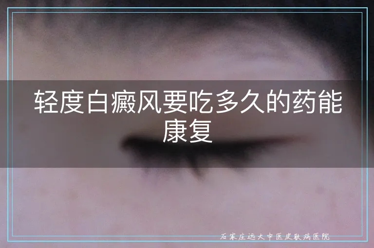轻度白癜风要吃多久的药能康复