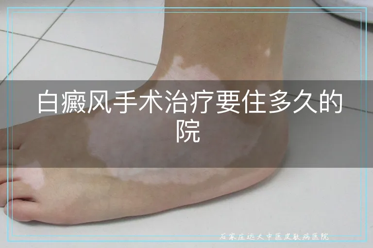 白癜风手术治疗要住多久的院