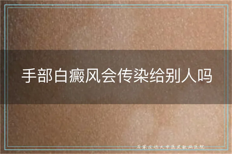 手部白癜风会传染给别人吗