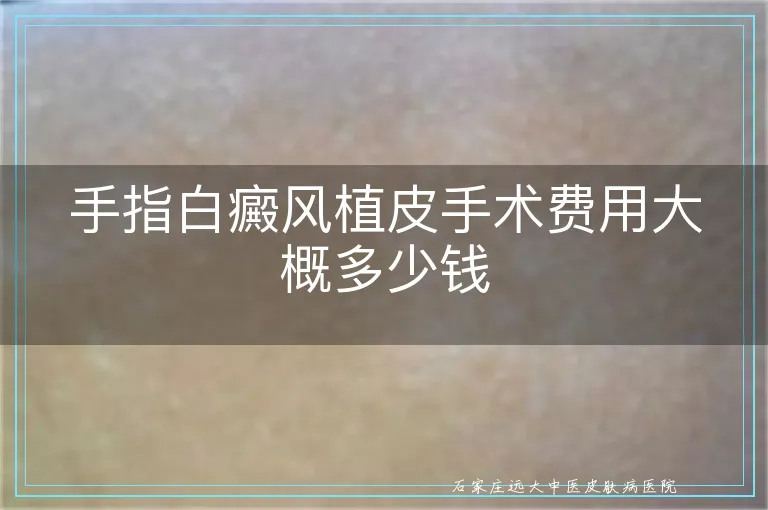 手指白癜风植皮手术费用大概多少钱