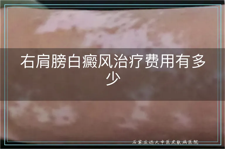 右肩膀白癜风治疗费用有多少