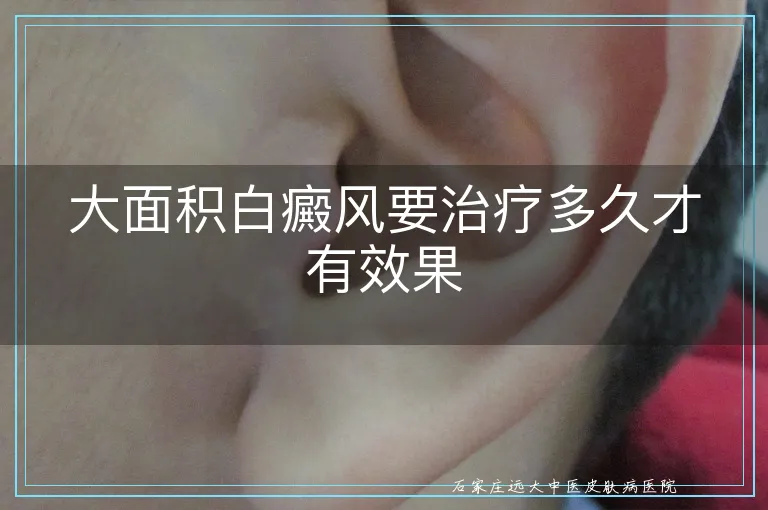 大面积白癜风要治疗多久才有效果