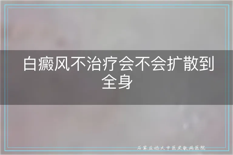 白癜风不治疗会不会扩散到全身