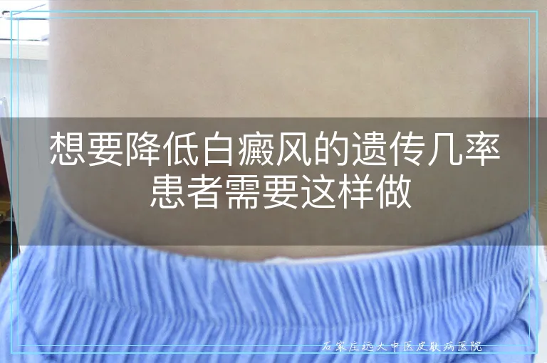 想要降低白癜风的遗传几率 患者需要这样做