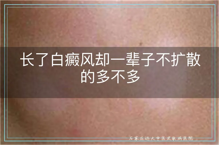 长了白癜风却一辈子不扩散的多不多