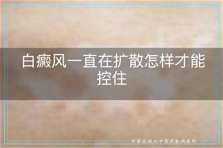 白癜风一直在扩散怎样才能控住