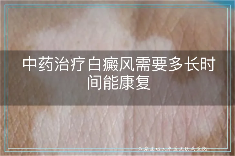 中药治疗白癜风需要多长时间能康复