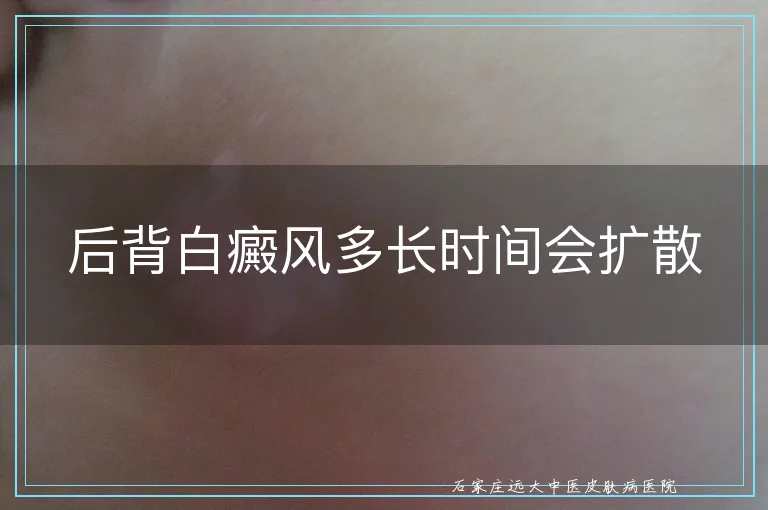 后背白癜风多长时间会扩散