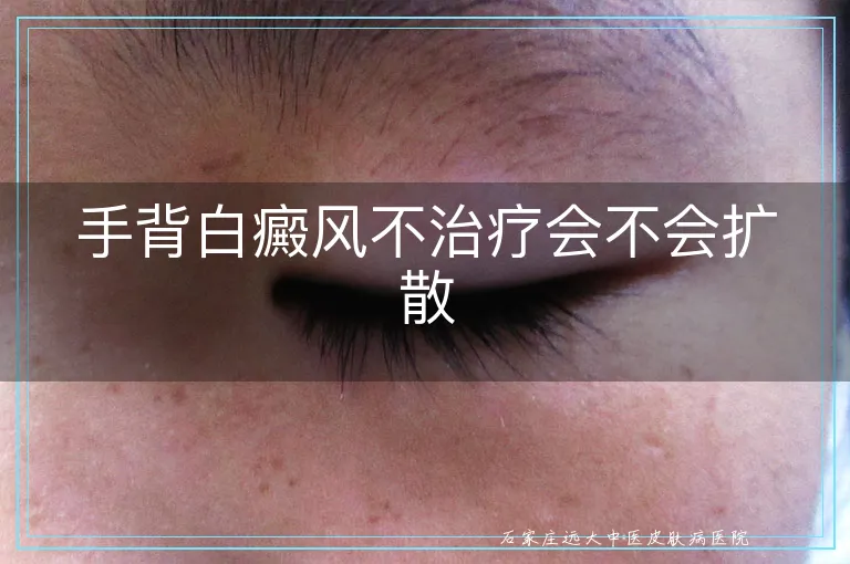 手背白癜风不治疗会不会扩散