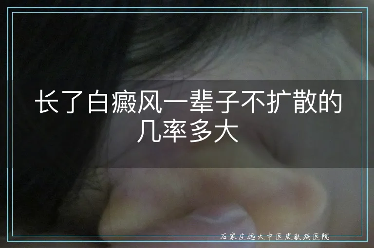 长了白癜风一辈子不扩散的几率多大
