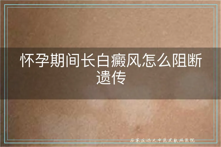 怀孕期间长白癜风怎么阻断遗传