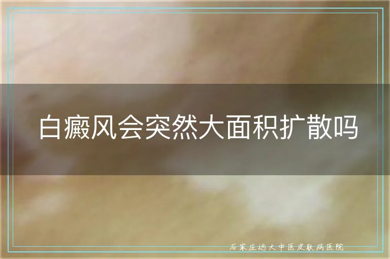 白癜风会突然大面积扩散吗
