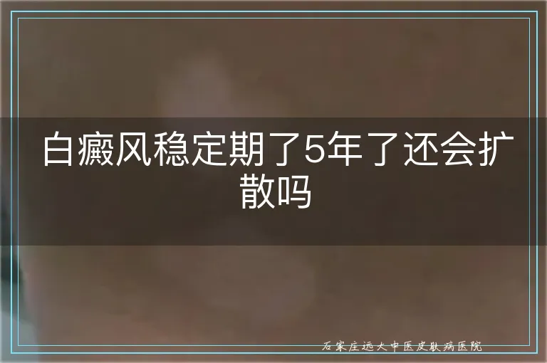 白癜风稳定期了5年了还会扩散吗