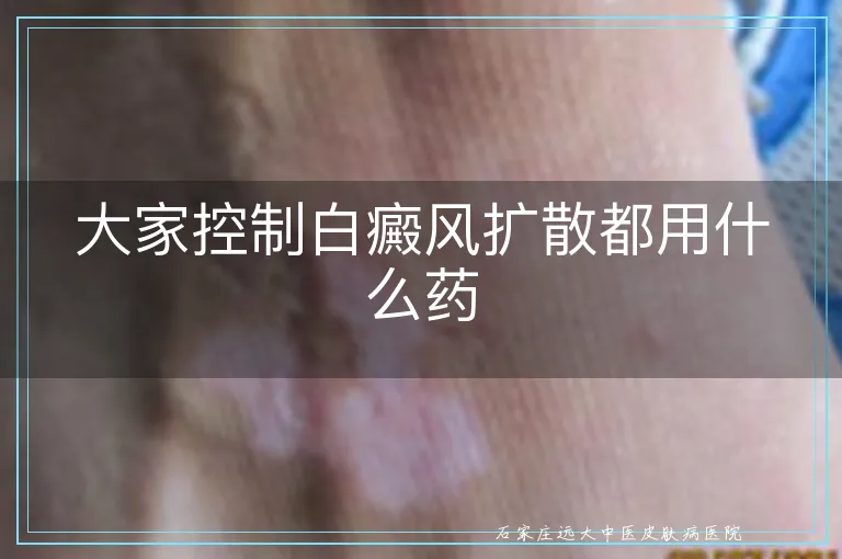 大家控制白癜风扩散都用什么药