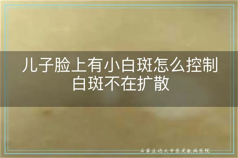 儿子脸上有小白斑怎么控制白斑不在扩散