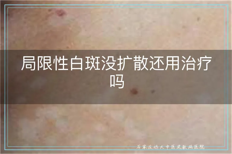 局限性白斑没扩散还用治疗吗