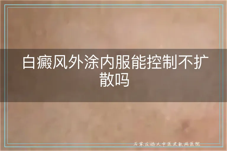 白癜风外涂内服能控制不扩散吗