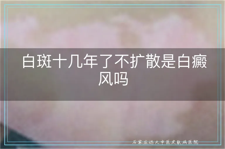 白斑十几年了不扩散是白癜风吗