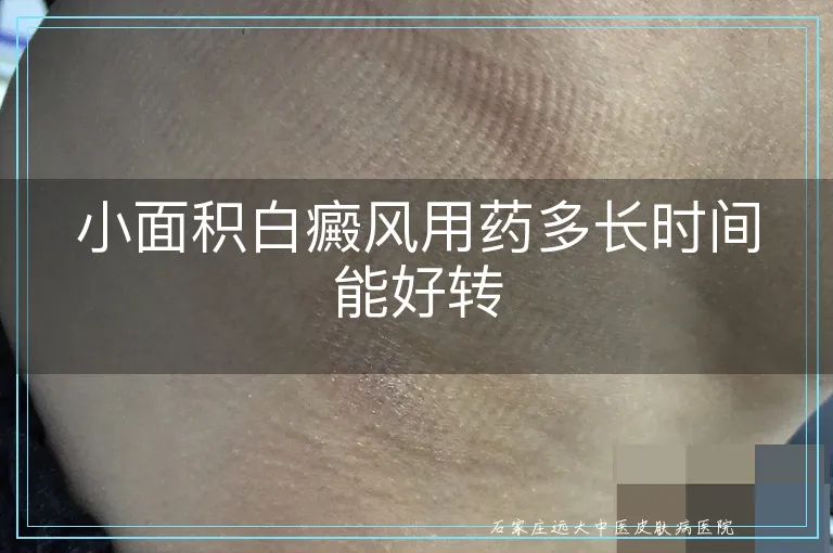 小面积白癜风用药多长时间能好转