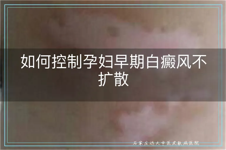 如何控制孕妇早期白癜风不扩散