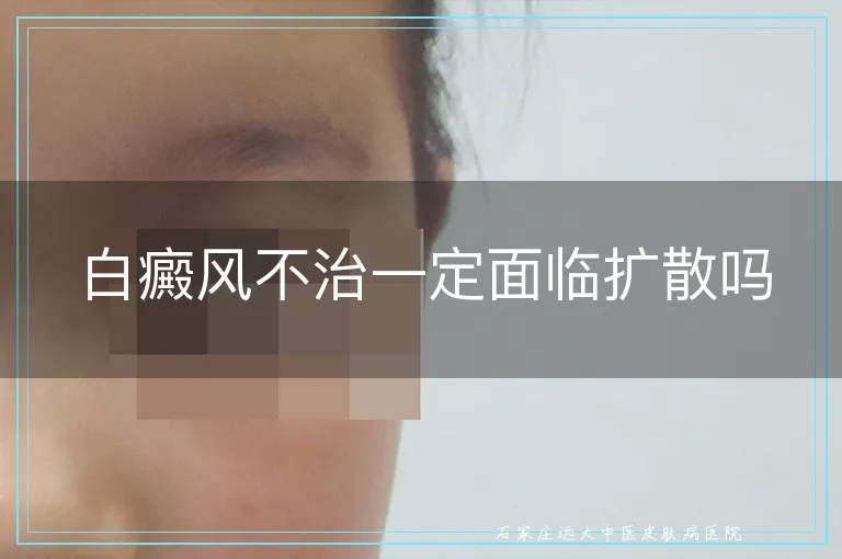 白癜风不治一定面临扩散吗