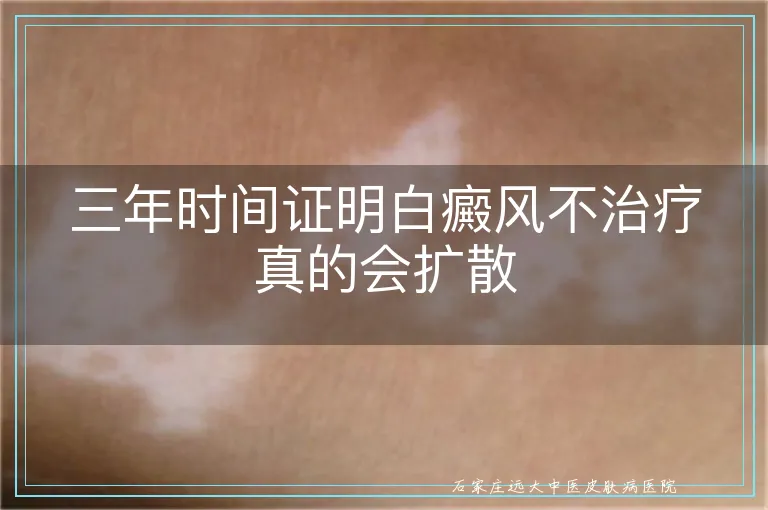 三年时间证明白癜风不治疗真的会扩散