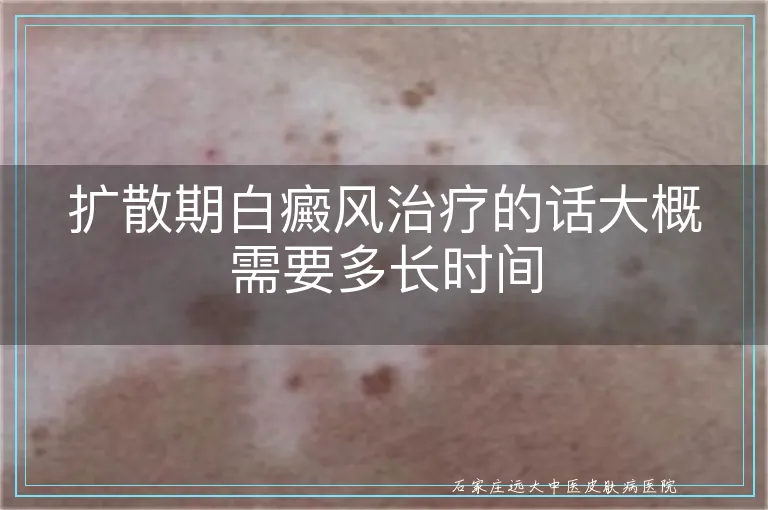 扩散期白癜风治疗的话大概需要多长时间
