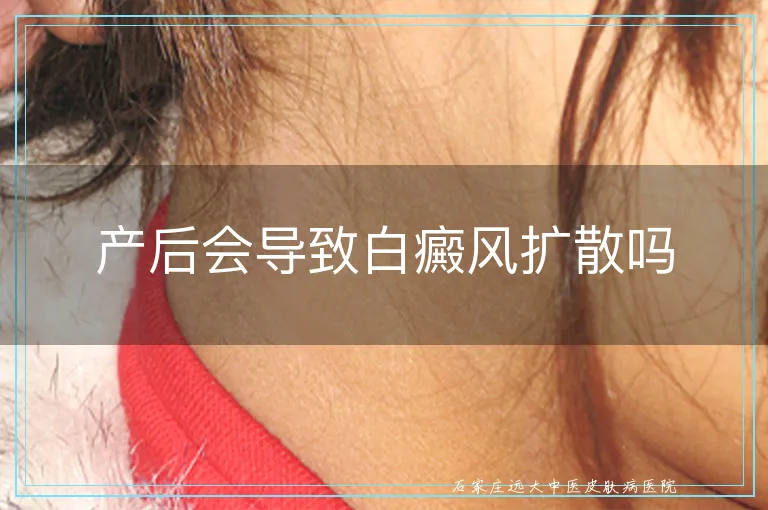 产后会导致白癜风扩散吗