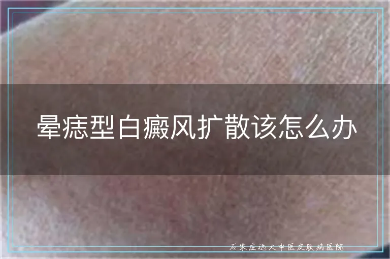 晕痣型白癜风扩散该怎么办