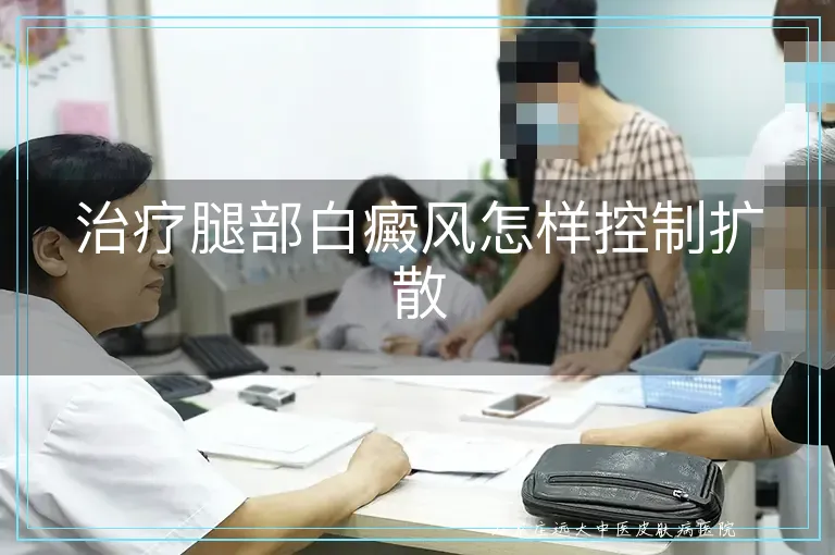 治疗腿部白癜风怎样控制扩散