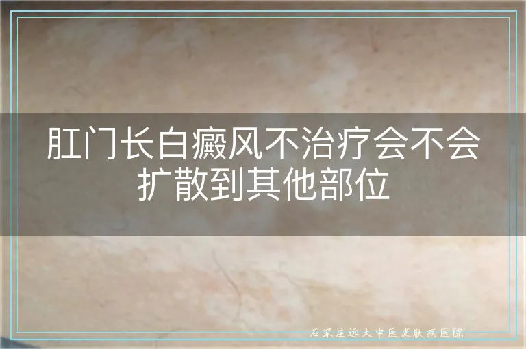 肛门长白癜风不治疗会不会扩散到其他部位