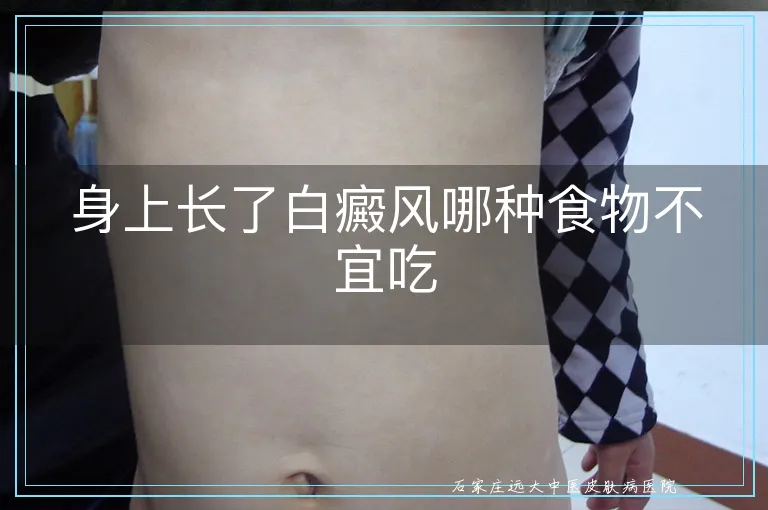 身上长了白癜风哪种食物不宜吃